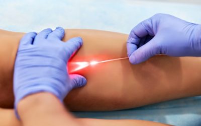 Why laser treatment for varicose veins is safe?