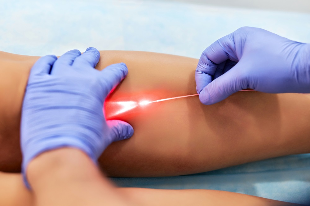 Why laser treatment for varicose veins is safe?